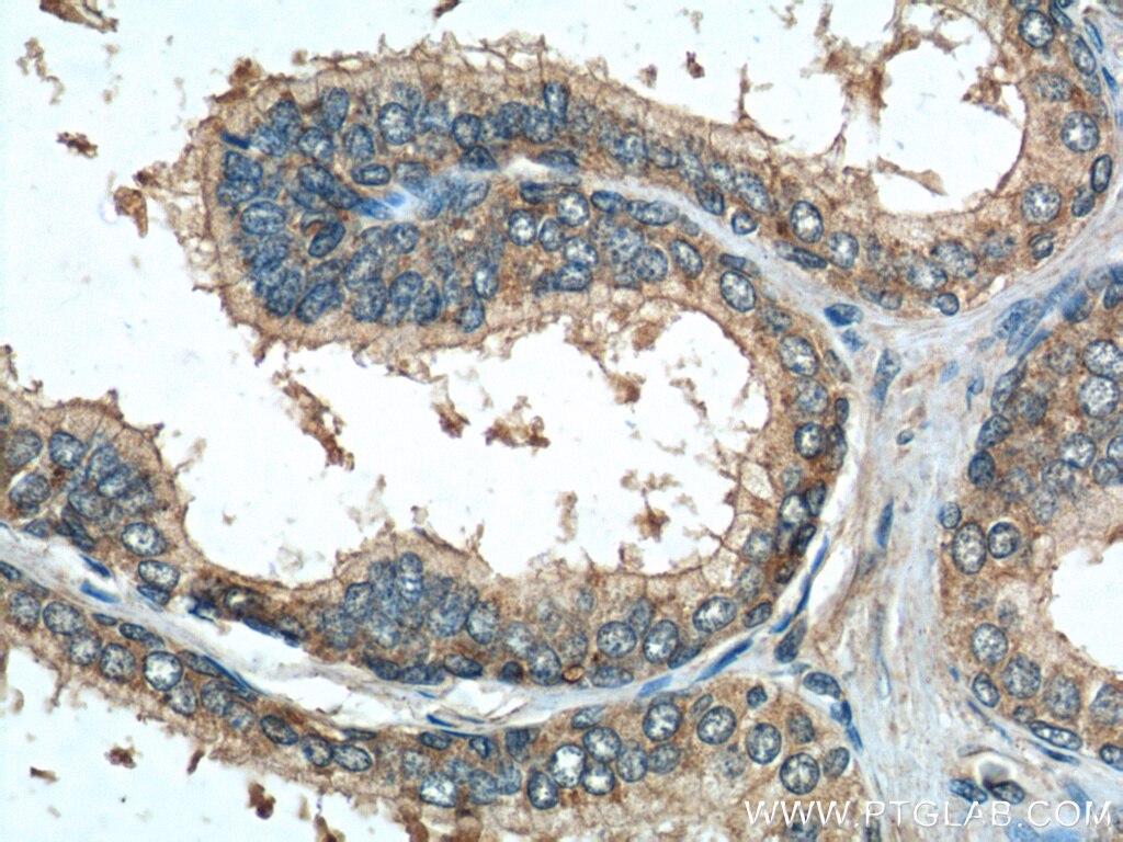 IHC staining of human prostate hyperplasia using 22652-1-AP