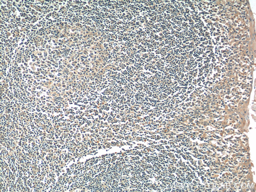 Immunohistochemistry (IHC) staining of human tonsillitis tissue using DNASE2B Polyclonal antibody (22652-1-AP)