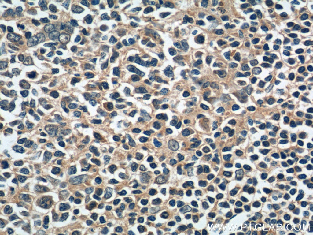 Immunohistochemistry (IHC) staining of human tonsillitis tissue using DNASE2B Polyclonal antibody (22652-1-AP)