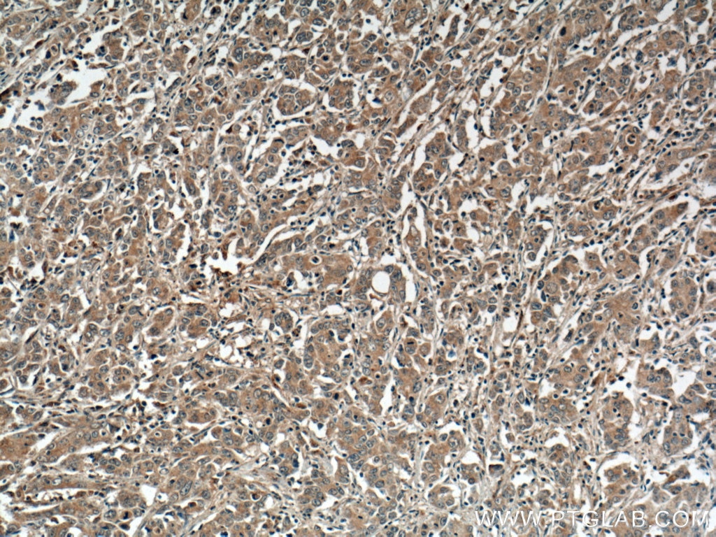 Immunohistochemistry (IHC) staining of human stomach cancer tissue using DNM3 Polyclonal antibody (14737-1-AP)