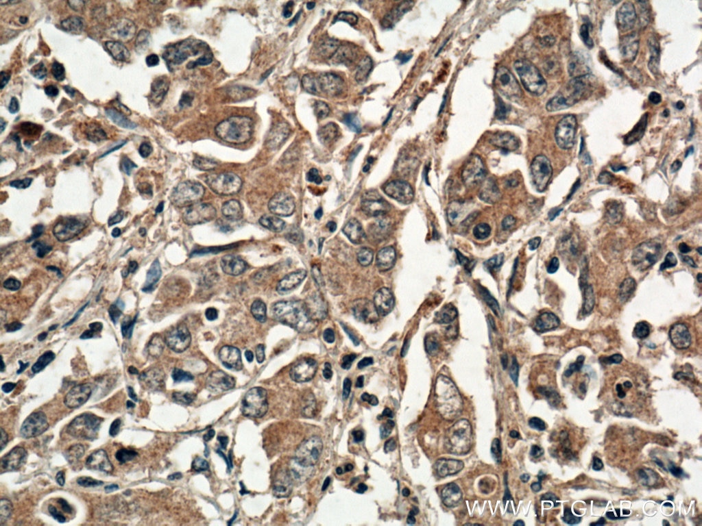 Immunohistochemistry (IHC) staining of human stomach cancer tissue using DNM3 Polyclonal antibody (14737-1-AP)