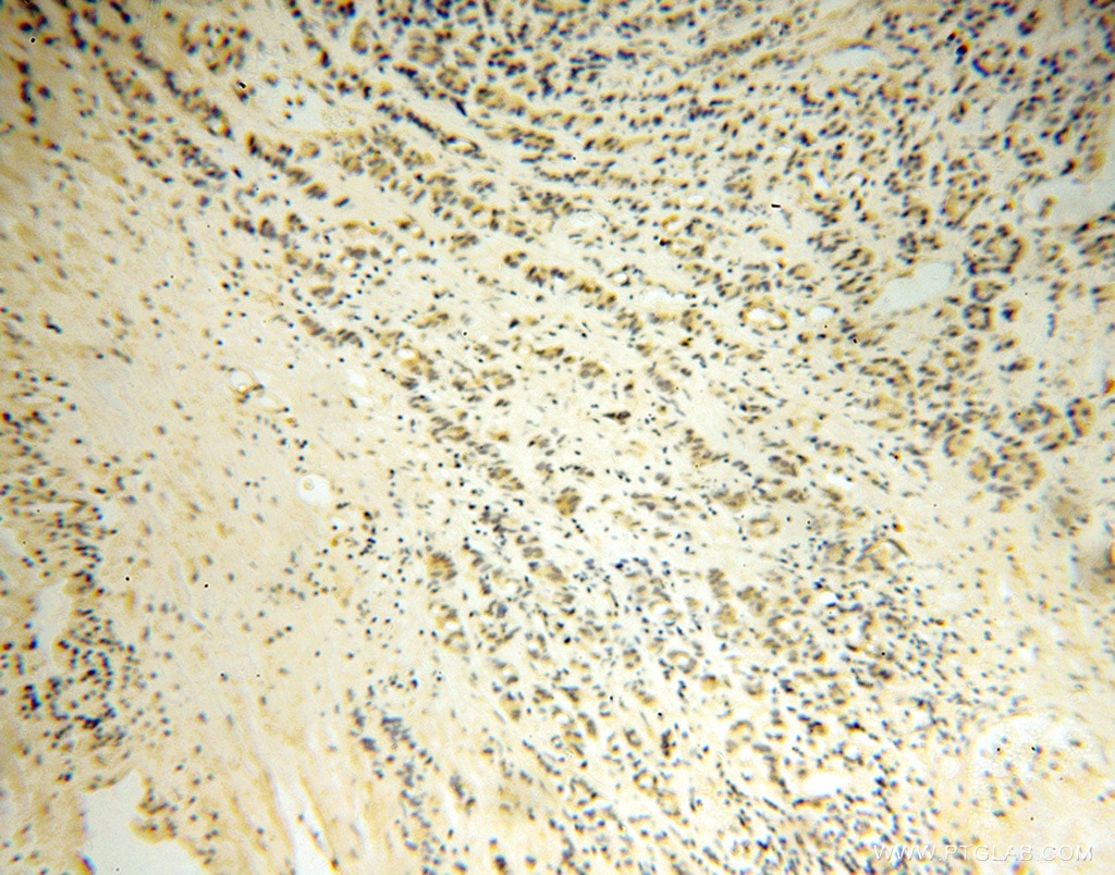 IHC staining of human gliomas using 14737-1-AP