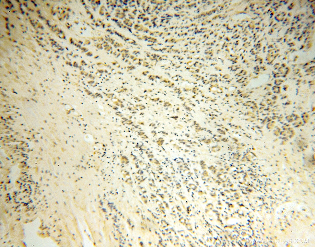 Immunohistochemistry (IHC) staining of human gliomas tissue using DNM3 Polyclonal antibody (14737-1-AP)