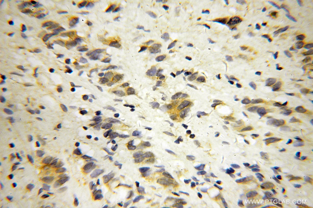 Immunohistochemistry (IHC) staining of human gliomas tissue using DNM3 Polyclonal antibody (14737-1-AP)