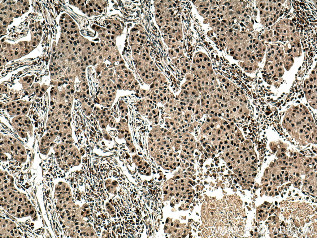 IHC staining of human breast cancer using 24206-1-AP