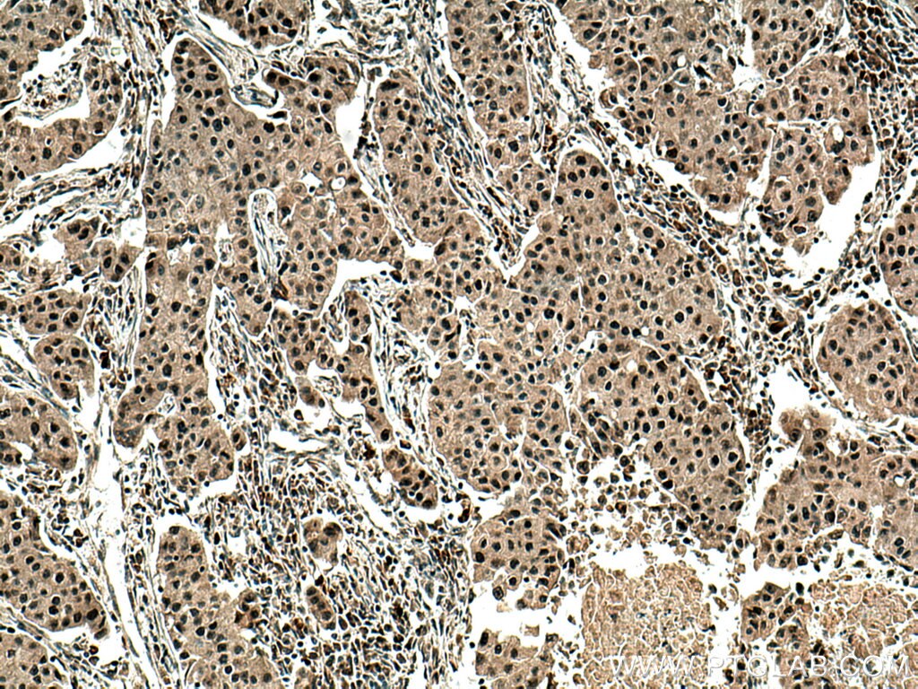 Immunohistochemistry (IHC) staining of human breast cancer tissue using DNMT1 Polyclonal antibody (24206-1-AP)