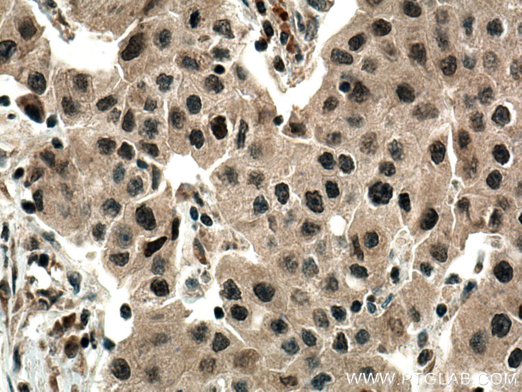 Immunohistochemistry (IHC) staining of human breast cancer tissue using DNMT1 Polyclonal antibody (24206-1-AP)