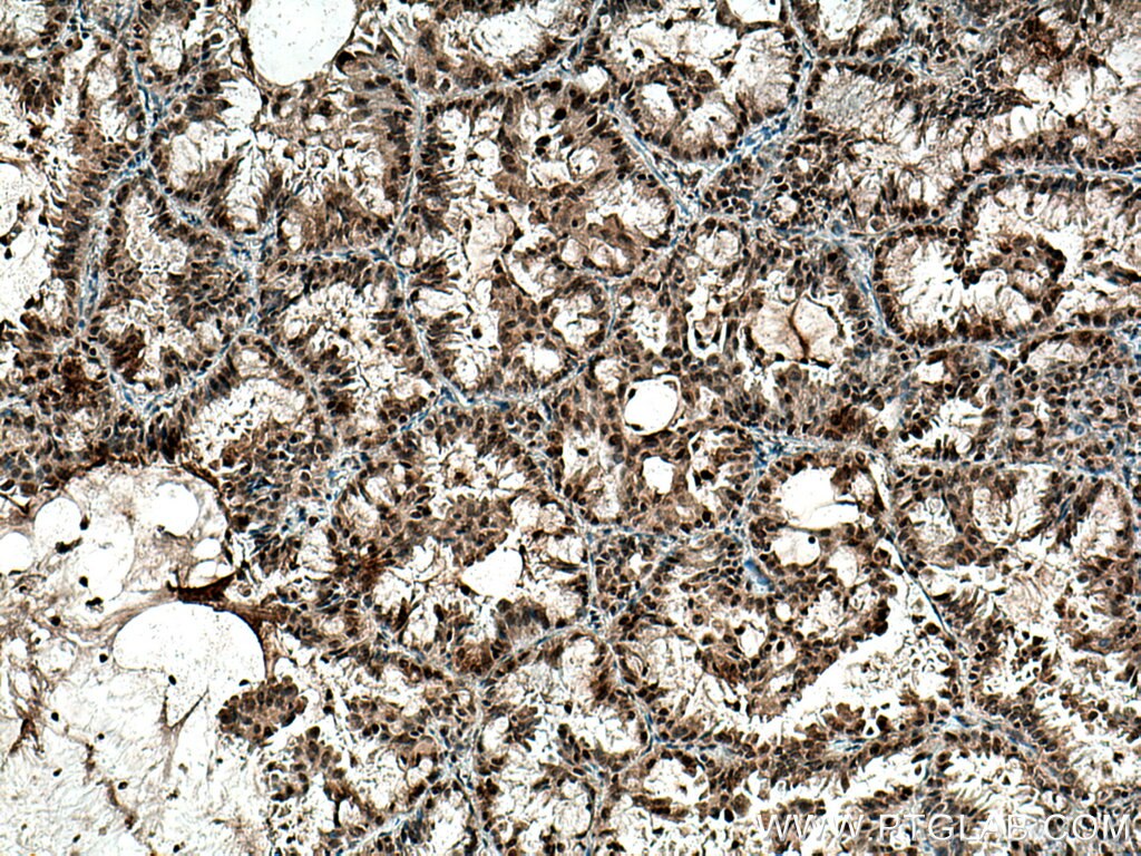 Immunohistochemistry (IHC) staining of human lung cancer tissue using DNMT1 Polyclonal antibody (24206-1-AP)