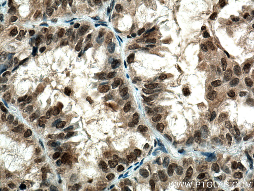 Immunohistochemistry (IHC) staining of human lung cancer tissue using DNMT1 Polyclonal antibody (24206-1-AP)