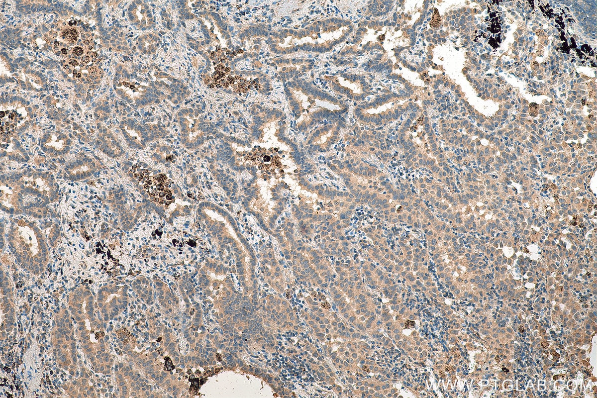 IHC staining of human lung cancer using 19366-1-AP