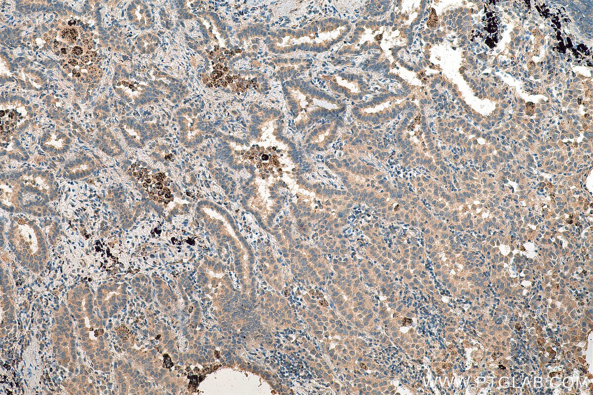 Immunohistochemistry (IHC) staining of human lung cancer tissue using DNMT3A Polyclonal antibody (19366-1-AP)