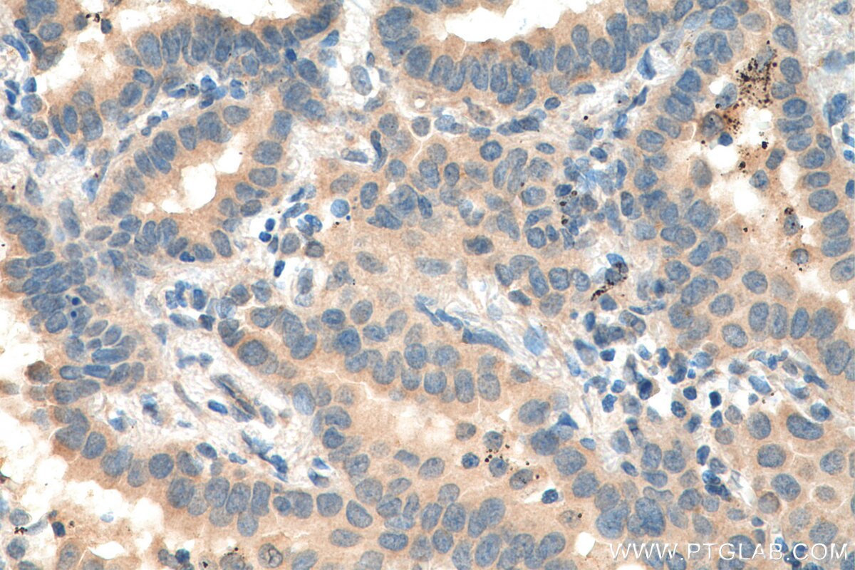 IHC staining of human lung cancer using 19366-1-AP