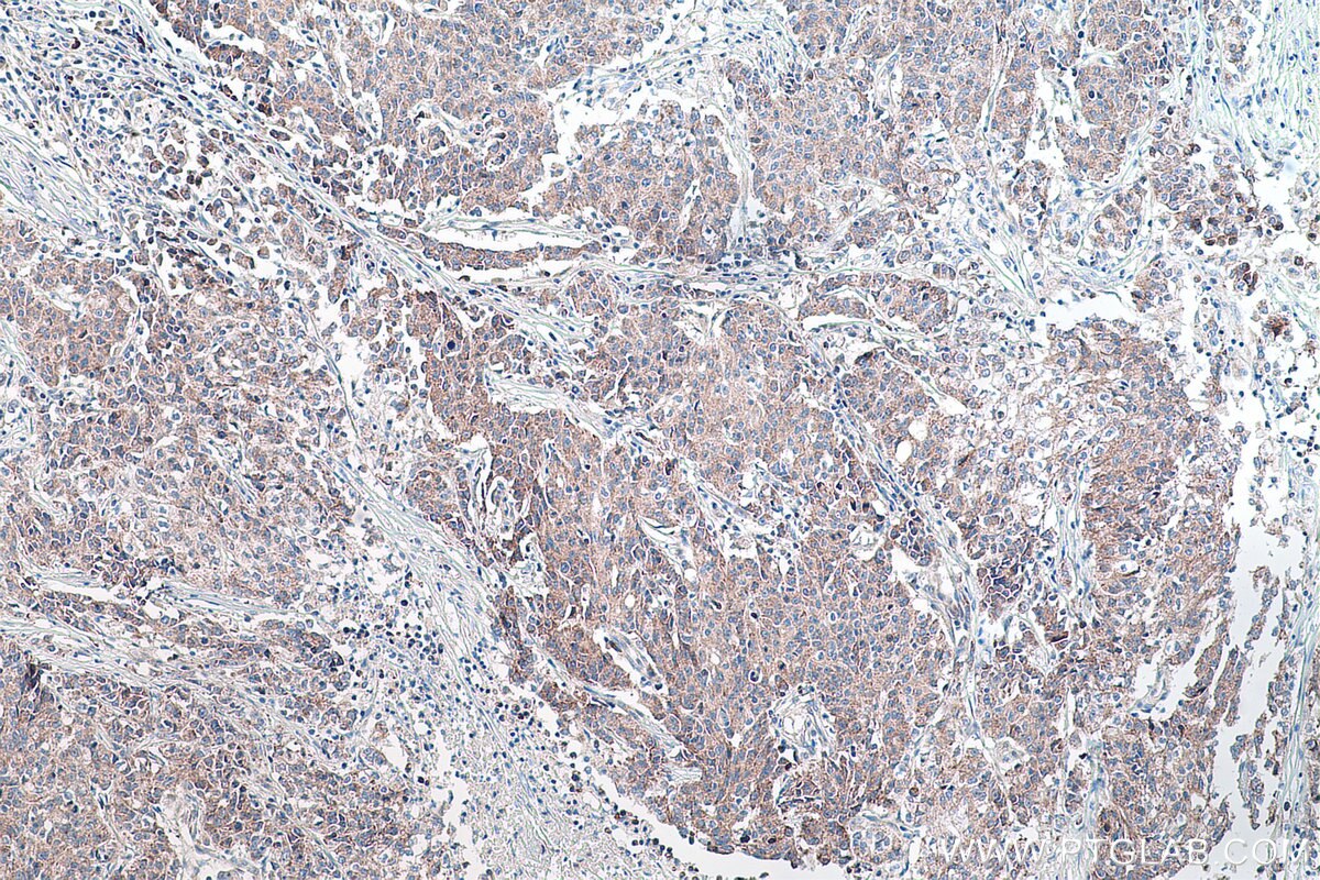 Immunohistochemistry (IHC) staining of human stomach cancer tissue using DNMT3A Polyclonal antibody (20954-1-AP)