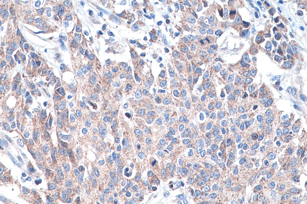 Immunohistochemistry (IHC) staining of human stomach cancer tissue using DNMT3A Polyclonal antibody (20954-1-AP)