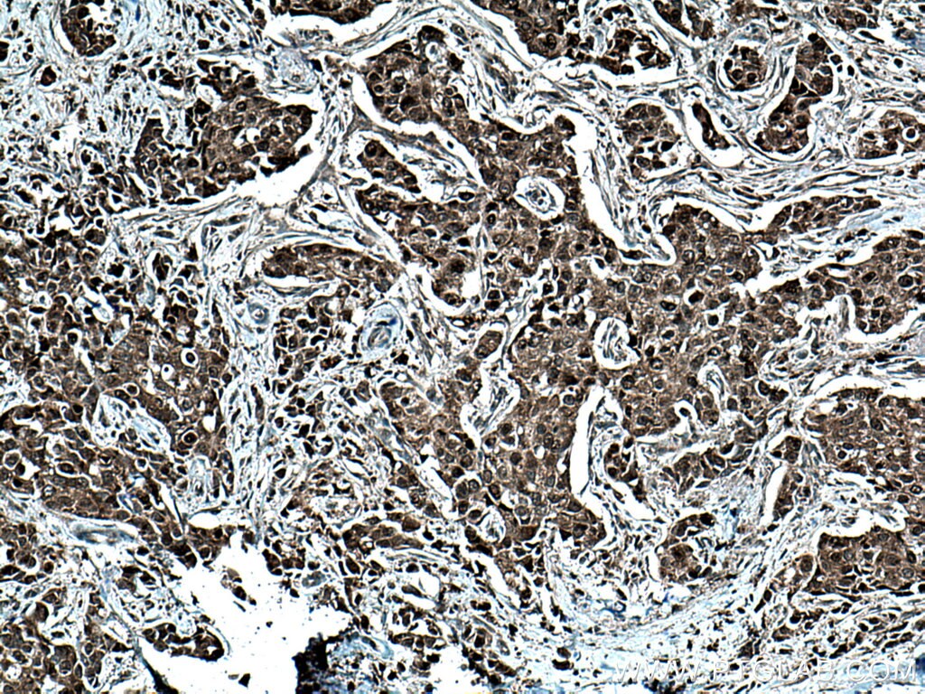 Immunohistochemistry (IHC) staining of human breast cancer tissue using DNMT3B Polyclonal antibody (26971-1-AP)