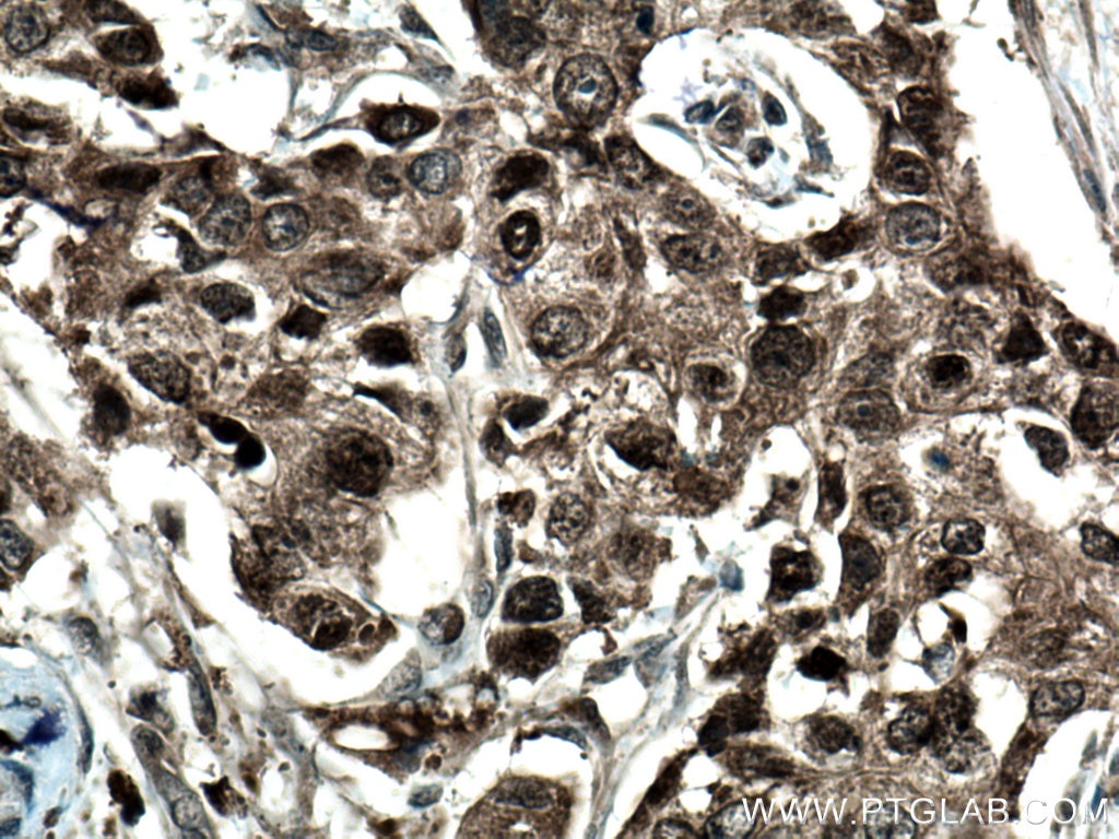 Immunohistochemistry (IHC) staining of human breast cancer tissue using DNMT3B Polyclonal antibody (26971-1-AP)