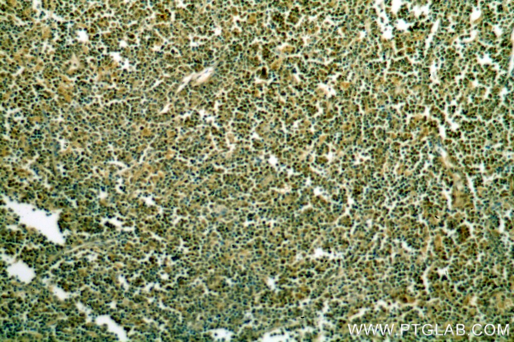 Immunohistochemistry (IHC) staining of human lymphoma tissue using DNTT,TDT Polyclonal antibody (17382-1-AP)