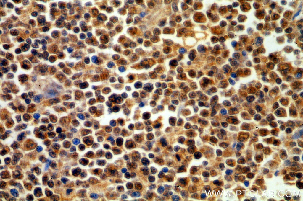 Immunohistochemistry (IHC) staining of human lymphoma tissue using DNTT,TDT Polyclonal antibody (17382-1-AP)