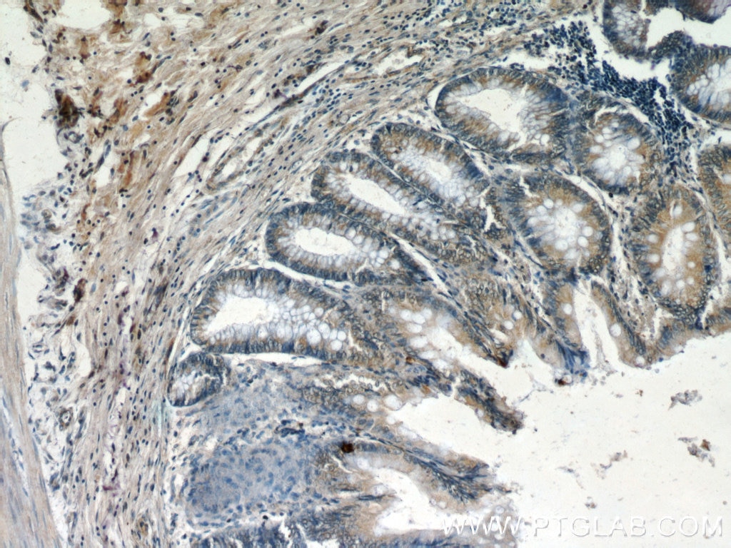 Immunohistochemistry (IHC) staining of human colon tissue using DOCK180 Polyclonal antibody (23421-1-AP)