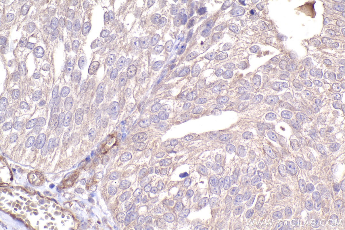 IHC staining of human ovary cancer using 67296-1-Ig (same clone as 67296-1-PBS) Immunohistochemistry (IHC) staining of human ovary cancer tissue using DOCK1 Monoclonal antibody (67296-1-Ig)