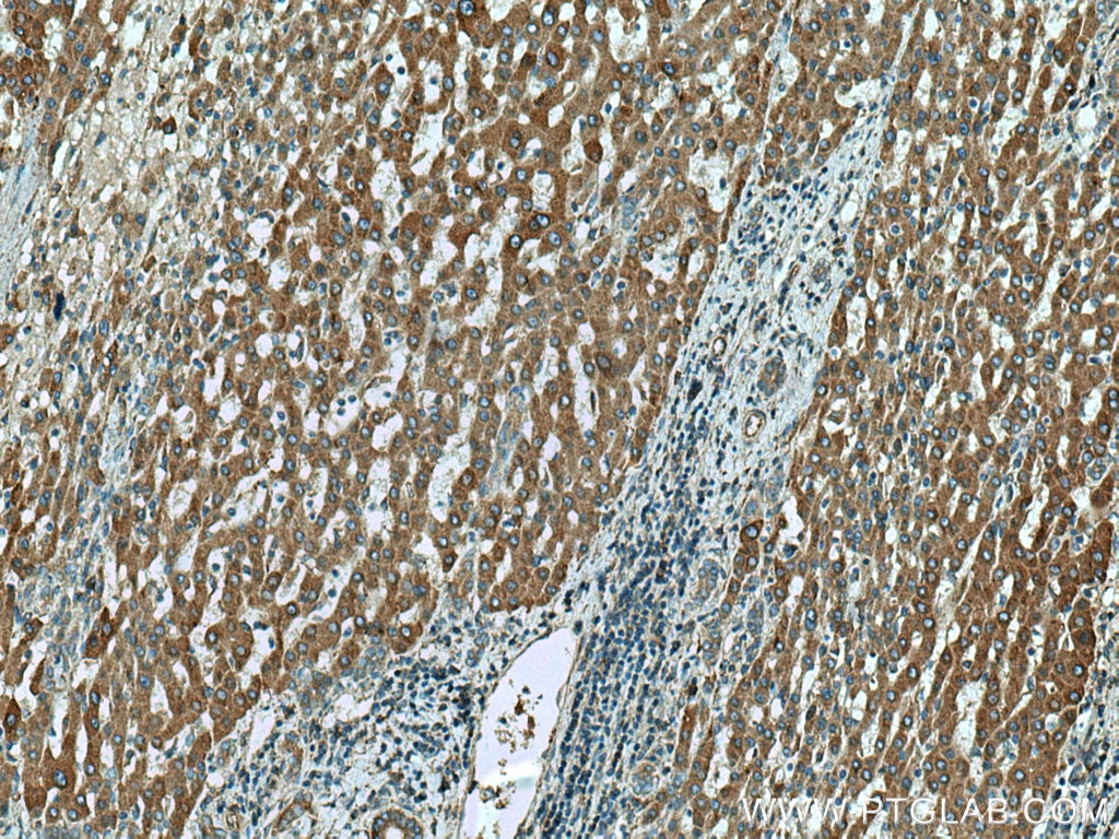 Immunohistochemistry (IHC) staining of human liver cancer tissue using DOCK2 Monoclonal antibody (66969-1-Ig)