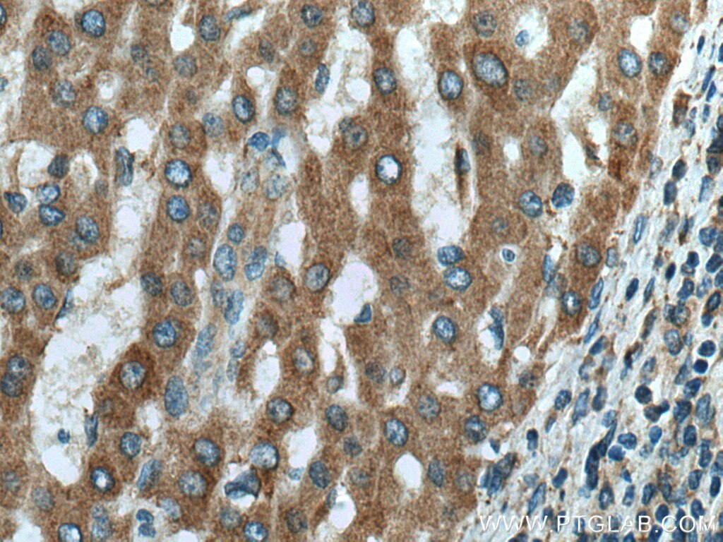 Immunohistochemistry (IHC) staining of human liver cancer tissue using DOCK2 Monoclonal antibody (66969-1-Ig)
