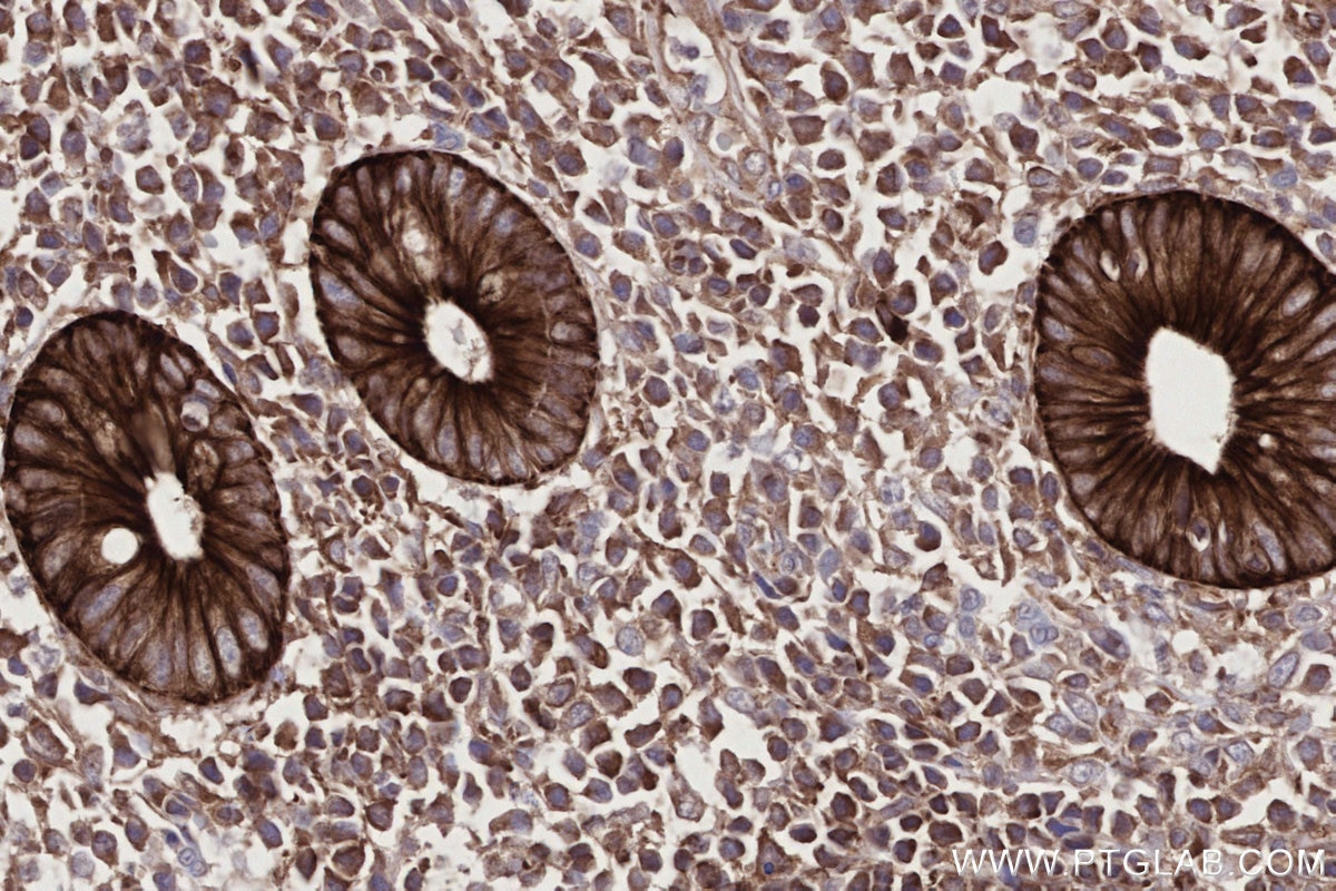 Immunohistochemistry (IHC) staining of human appendicitis tissue using DOCK2 Monoclonal antibody (66969-1-Ig)