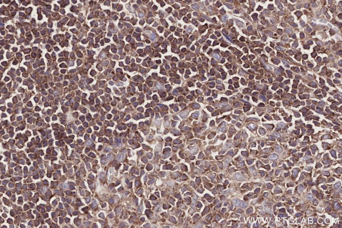 Immunohistochemistry (IHC) staining of human appendicitis tissue using DOCK2 Monoclonal antibody (66969-1-Ig)