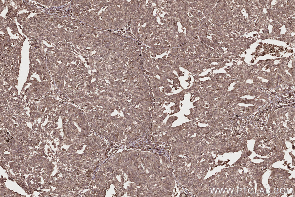 Immunohistochemistry (IHC) staining of human ovary cancer tissue using DOCK3; MOCA Polyclonal antibody (20683-1-AP)