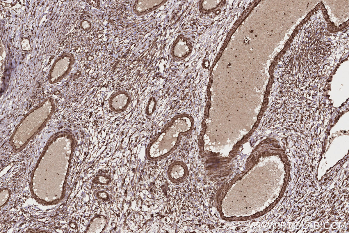 Immunohistochemistry (IHC) staining of human ovary cancer tissue using DOCK3; MOCA Polyclonal antibody (20683-1-AP)