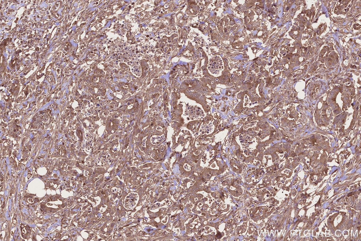 Immunohistochemistry (IHC) staining of human rectal cancer tissue using DOCK4 Polyclonal antibody (21861-1-AP)