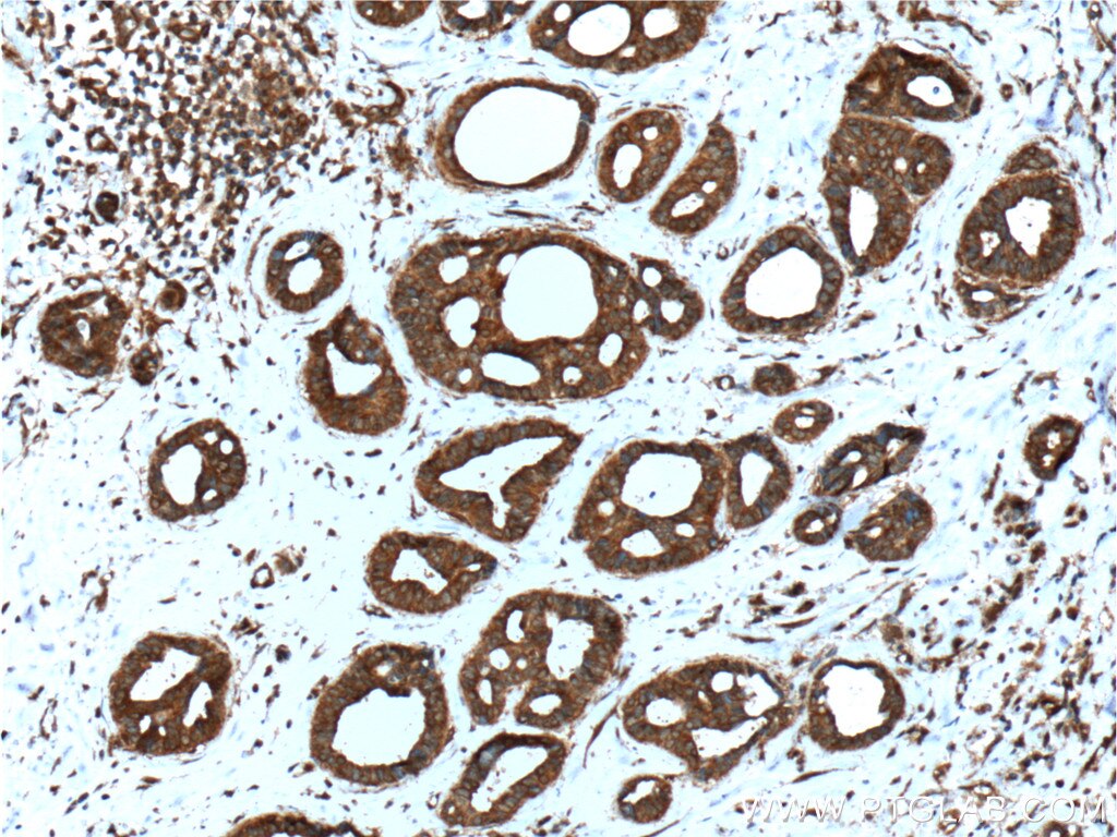 Immunohistochemistry (IHC) staining of human breast cancer tissue using DOCK4 Polyclonal antibody (21861-1-AP)