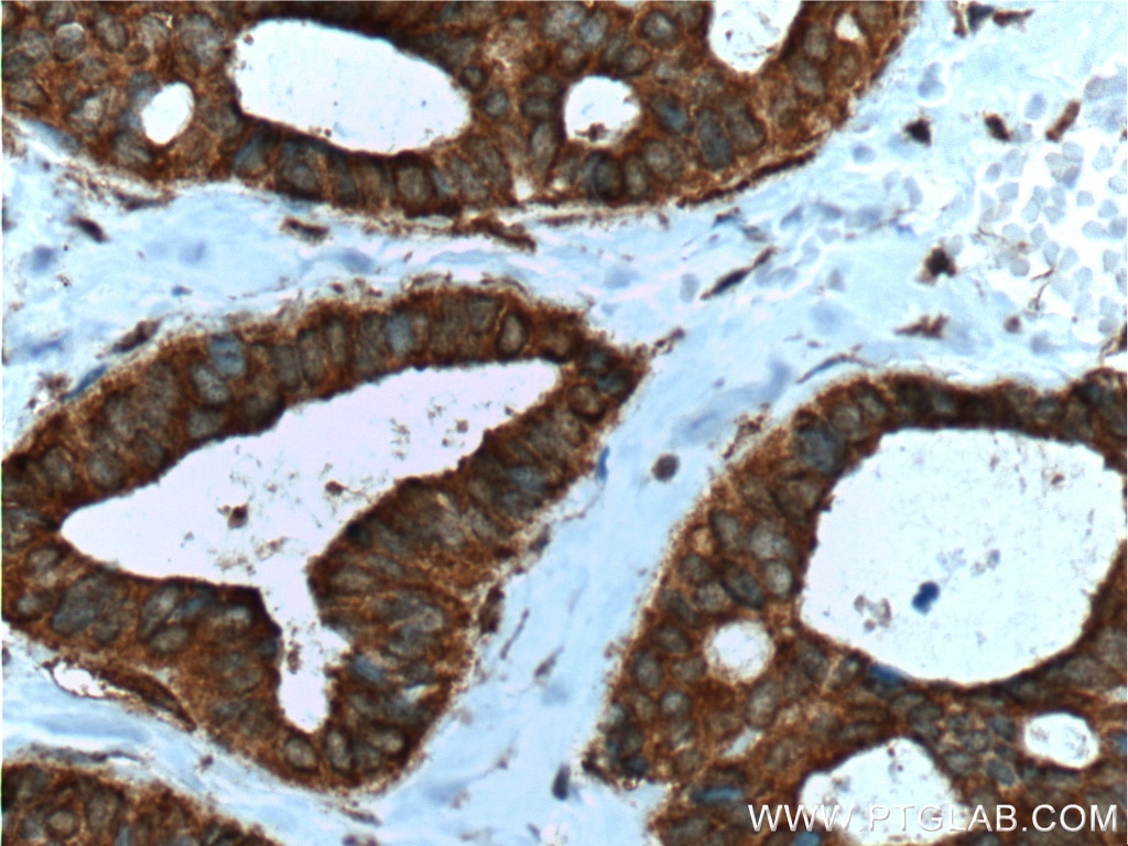 Immunohistochemistry (IHC) staining of human breast cancer tissue using DOCK4 Polyclonal antibody (21861-1-AP)