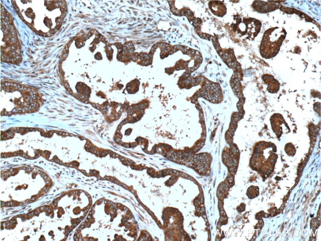 IHC staining of human ovary tumor using 21861-1-AP