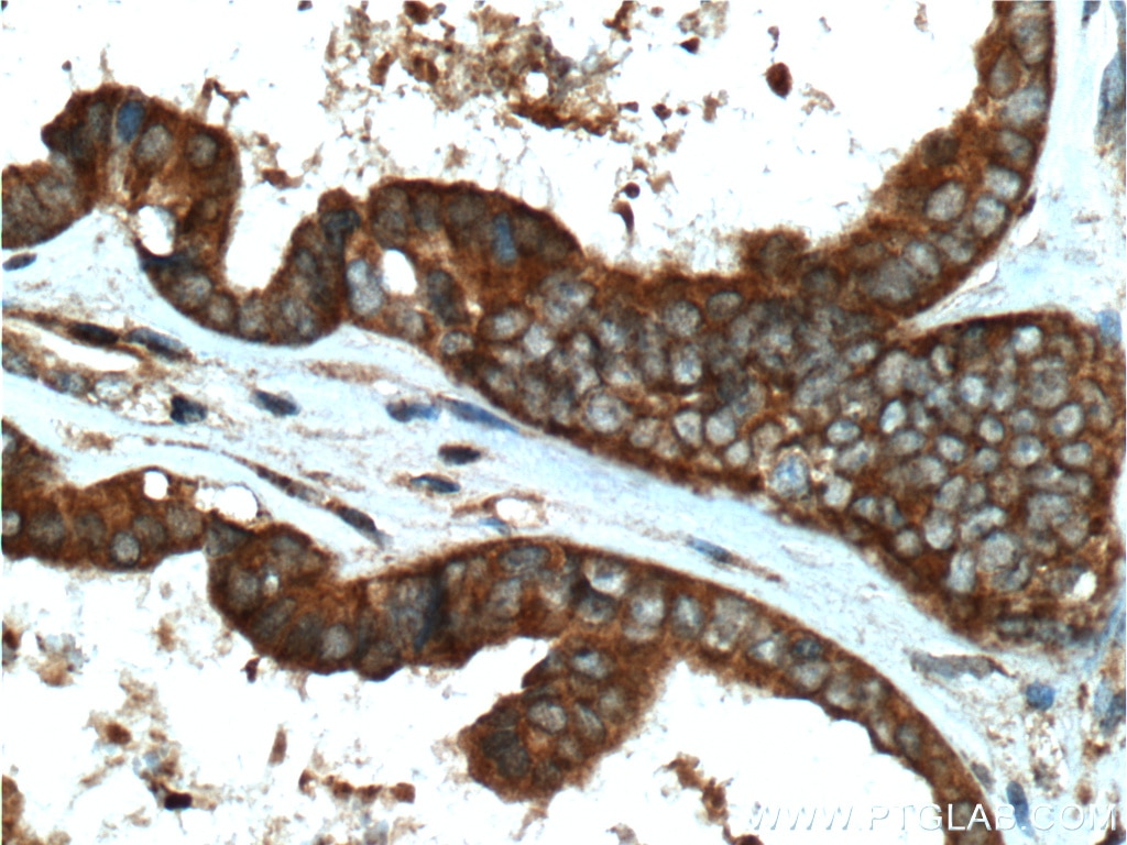 Immunohistochemistry (IHC) staining of human ovary tumor tissue using DOCK4 Polyclonal antibody (21861-1-AP)