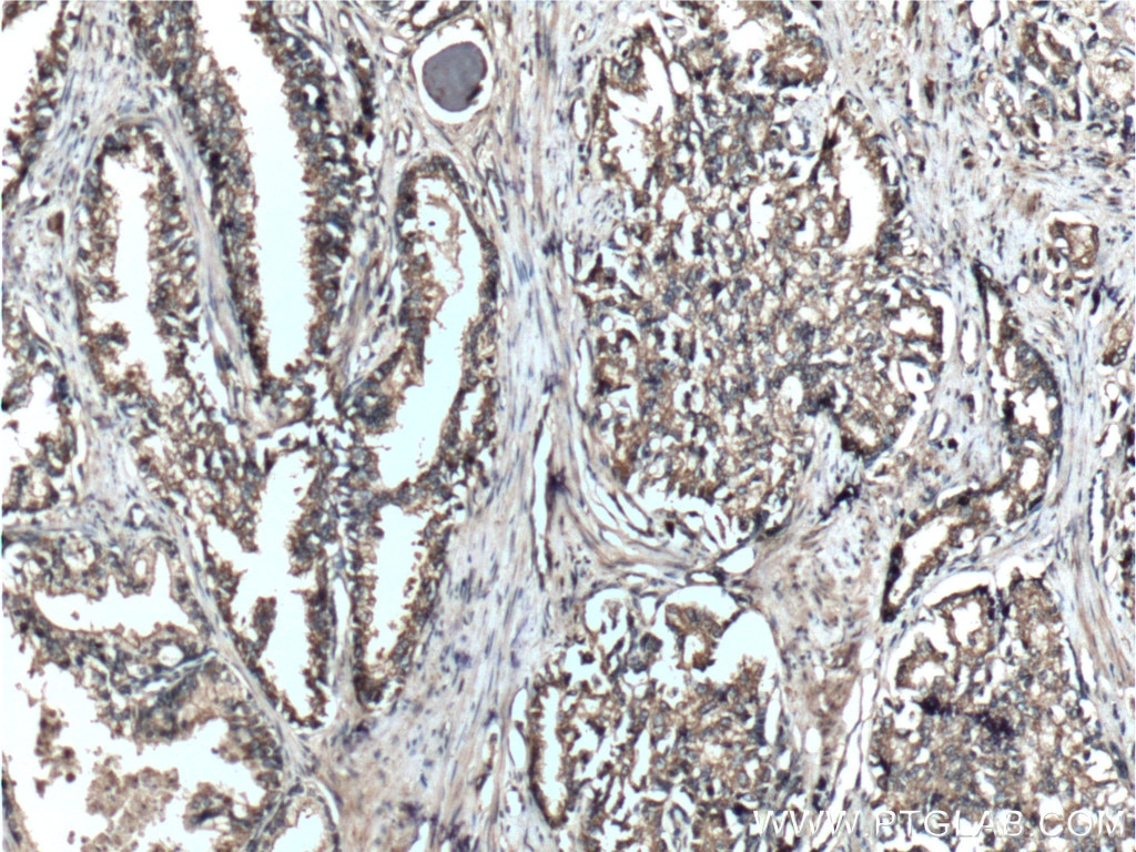 Immunohistochemistry (IHC) staining of human prostate cancer tissue using DOCK4 Polyclonal antibody (21861-1-AP)