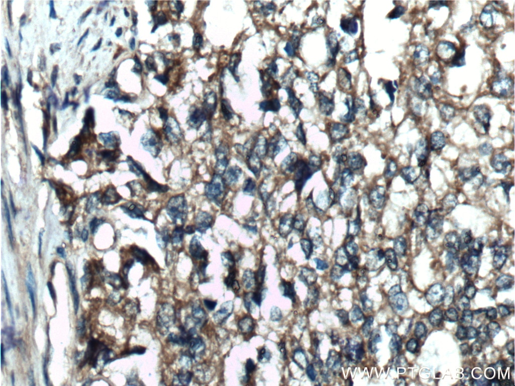 Immunohistochemistry (IHC) staining of human prostate cancer tissue using DOCK4 Polyclonal antibody (21861-1-AP)