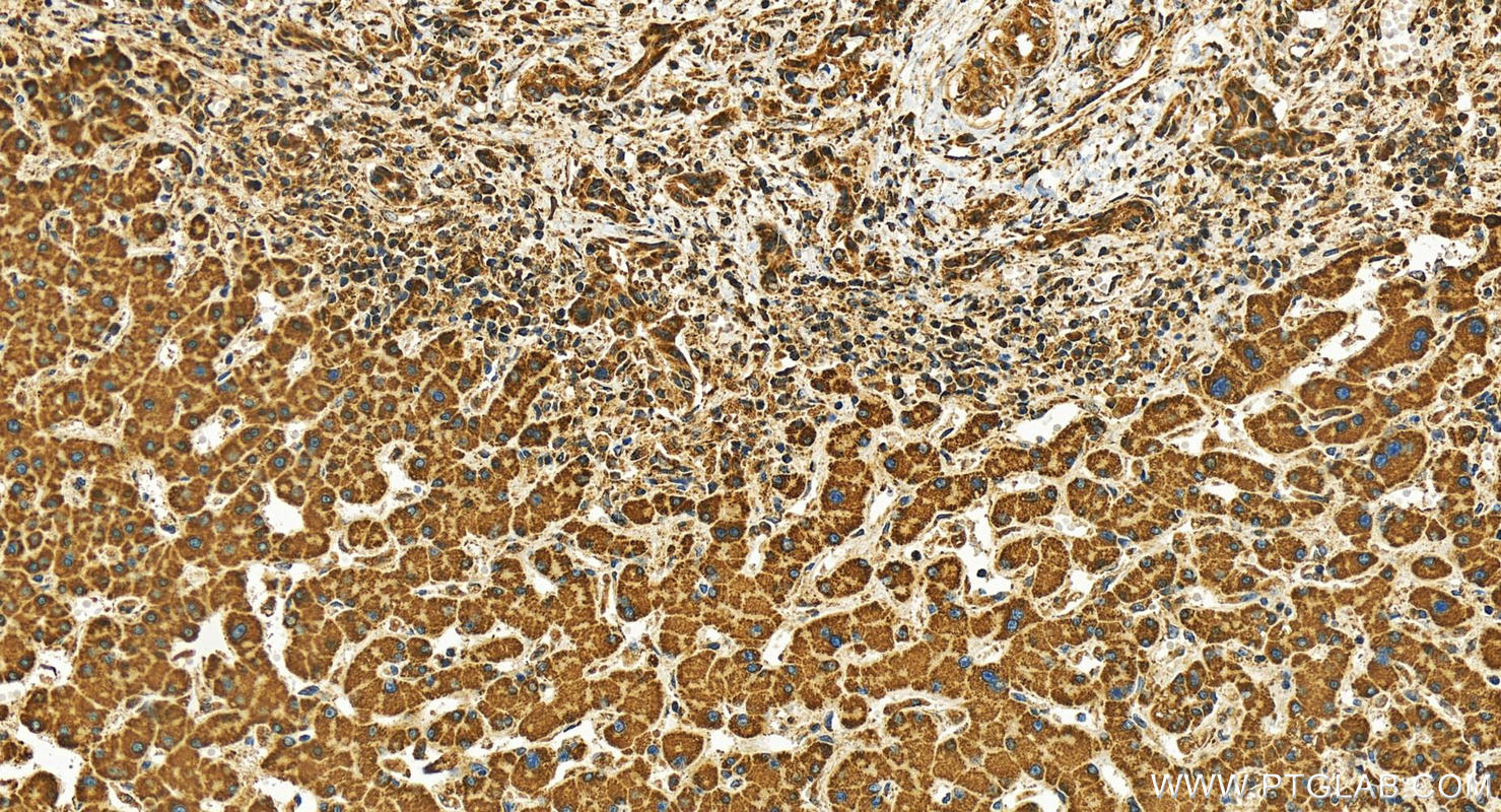 Immunohistochemistry (IHC) staining of human intrahepatic cholangiocarcinoma tissue using DOCK5 Polyclonal antibody (29938-1-AP)