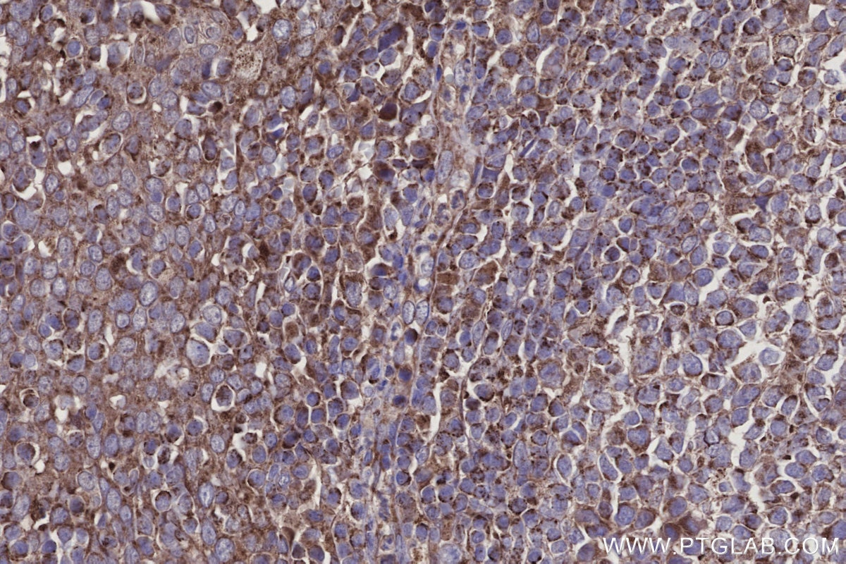 Immunohistochemistry (IHC) staining of human tonsillitis tissue using DOCK5 Polyclonal antibody (29938-1-AP)