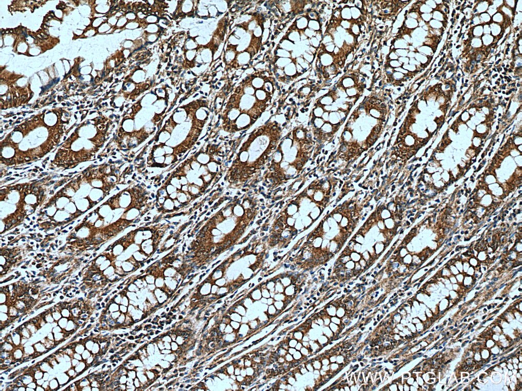 Immunohistochemistry (IHC) staining of human colon cancer tissue using DOCK6 Polyclonal antibody (25087-1-AP)