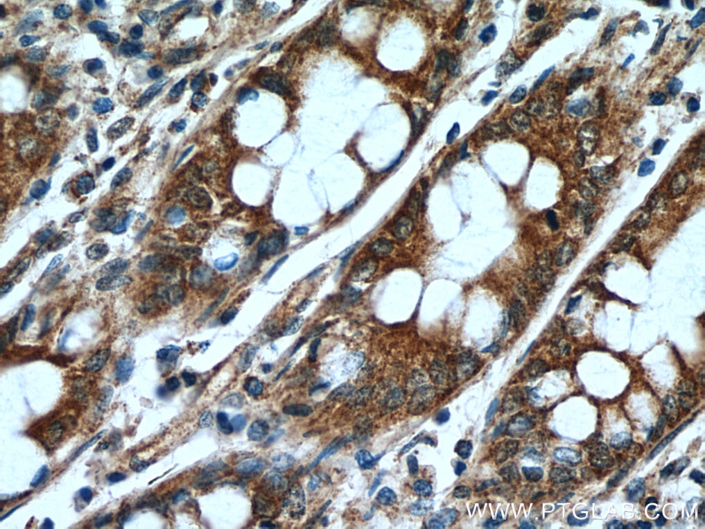 Immunohistochemistry (IHC) staining of human colon cancer tissue using DOCK6 Polyclonal antibody (25087-1-AP)
