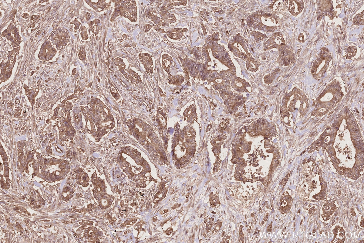 IHC staining of human rectal cancer using 25087-1-AP Immunohistochemistry (IHC) staining of human rectal cancer tissue using DOCK6 Polyclonal antibody (25087-1-AP)