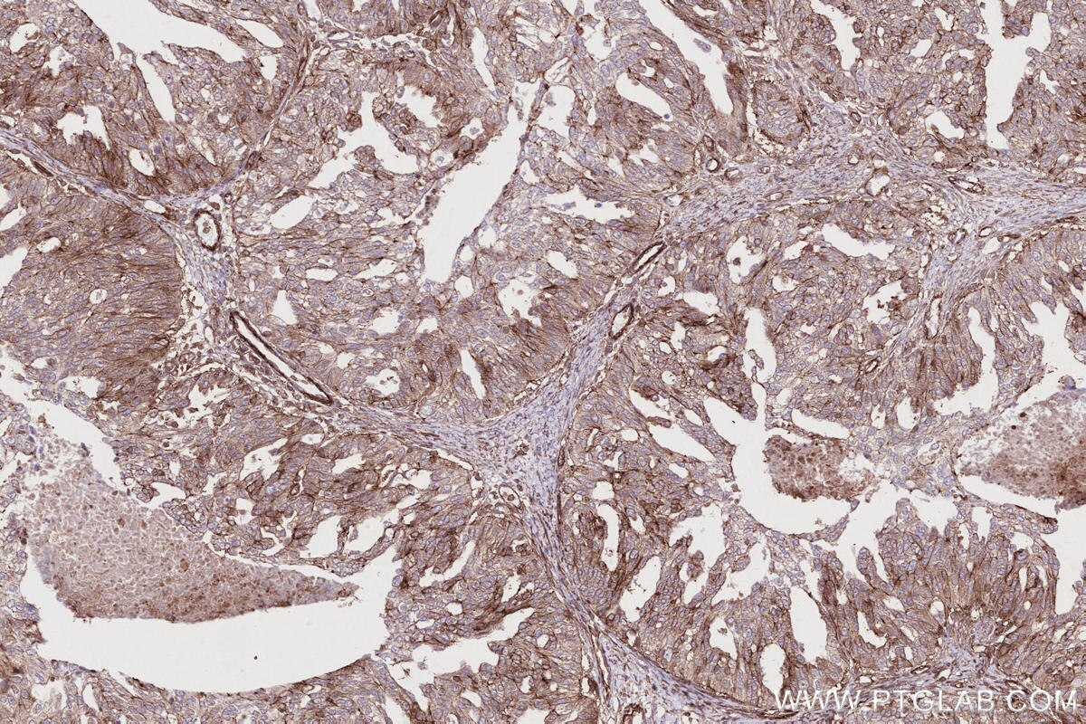 IHC staining of human ovary cancer using 83270-2-RR Immunohistochemistry (IHC) staining of human ovary cancer tissue using DOCK8 Recombinant monoclonal antibody (83270-2-RR)