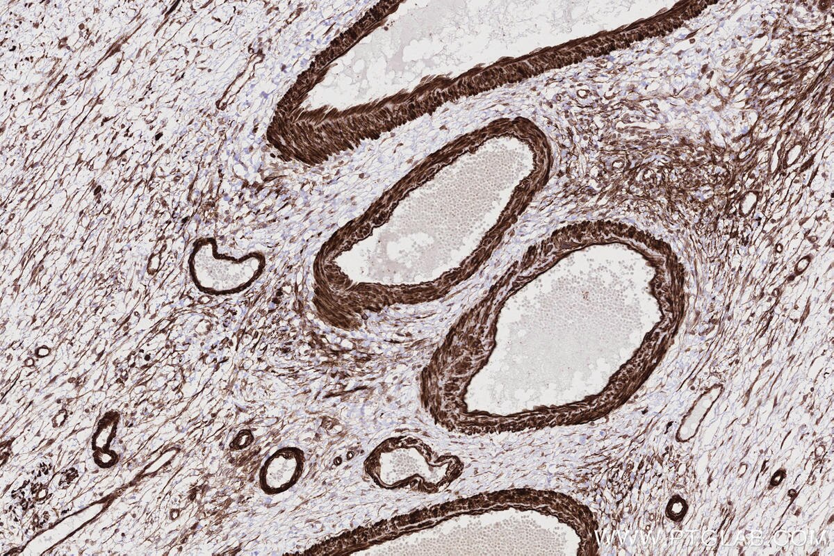 IHC staining of human ovary cancer using 83270-2-RR Immunohistochemistry (IHC) staining of human ovary cancer tissue using DOCK8 Recombinant monoclonal antibody (83270-2-RR)