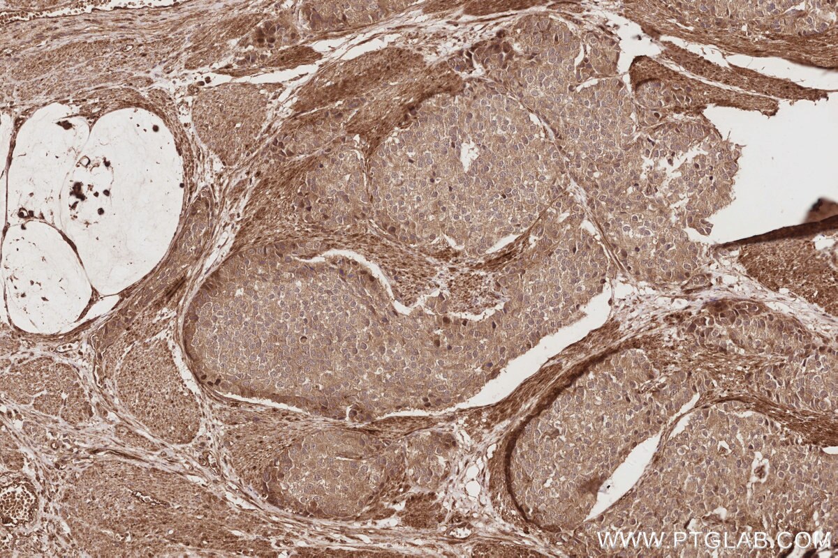 Immunohistochemistry (IHC) staining of human stomach cancer tissue using DOCK9 Polyclonal antibody (18987-1-AP)