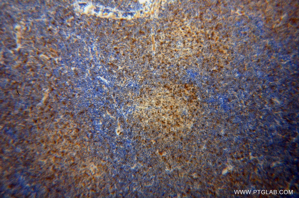 Immunohistochemistry (IHC) staining of human lymphoma tissue using DOK2 Polyclonal antibody (14087-1-AP)