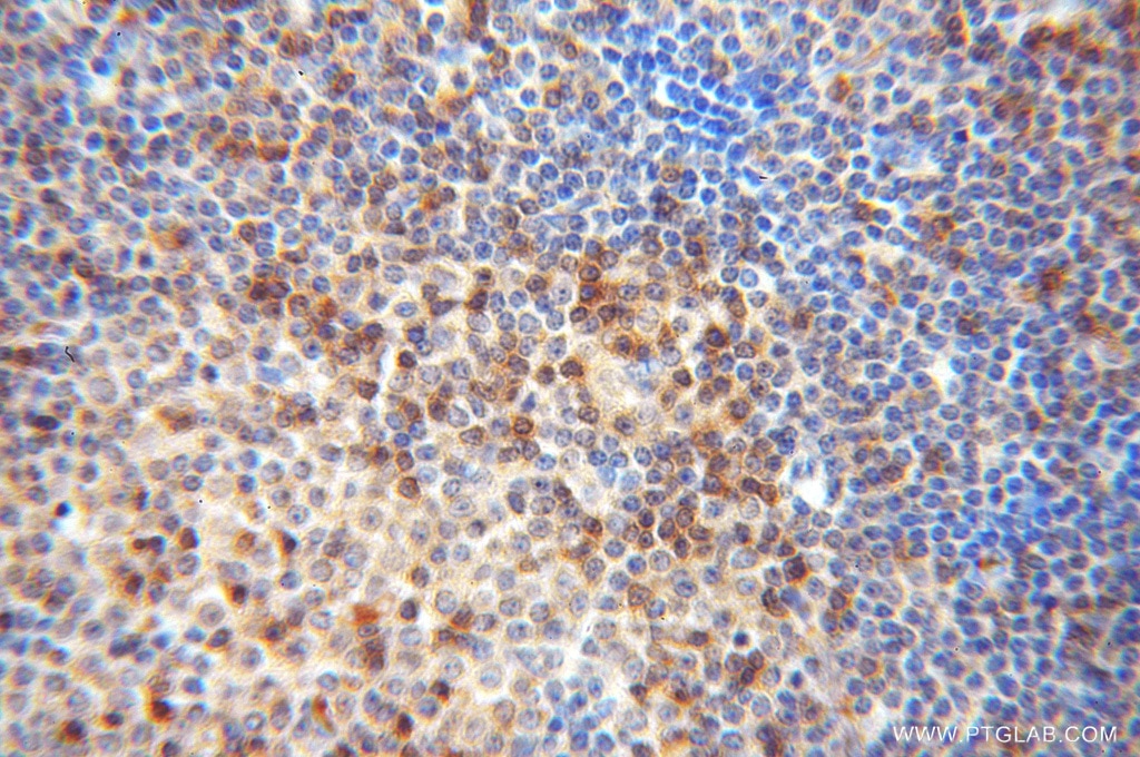 Immunohistochemistry (IHC) staining of human lymphoma tissue using DOK2 Polyclonal antibody (14087-1-AP)