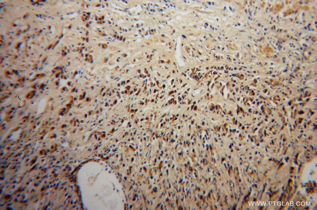 Immunohistochemistry (IHC) staining of human prostate cancer tissue using DOK4 Polyclonal antibody (10481-2-AP)