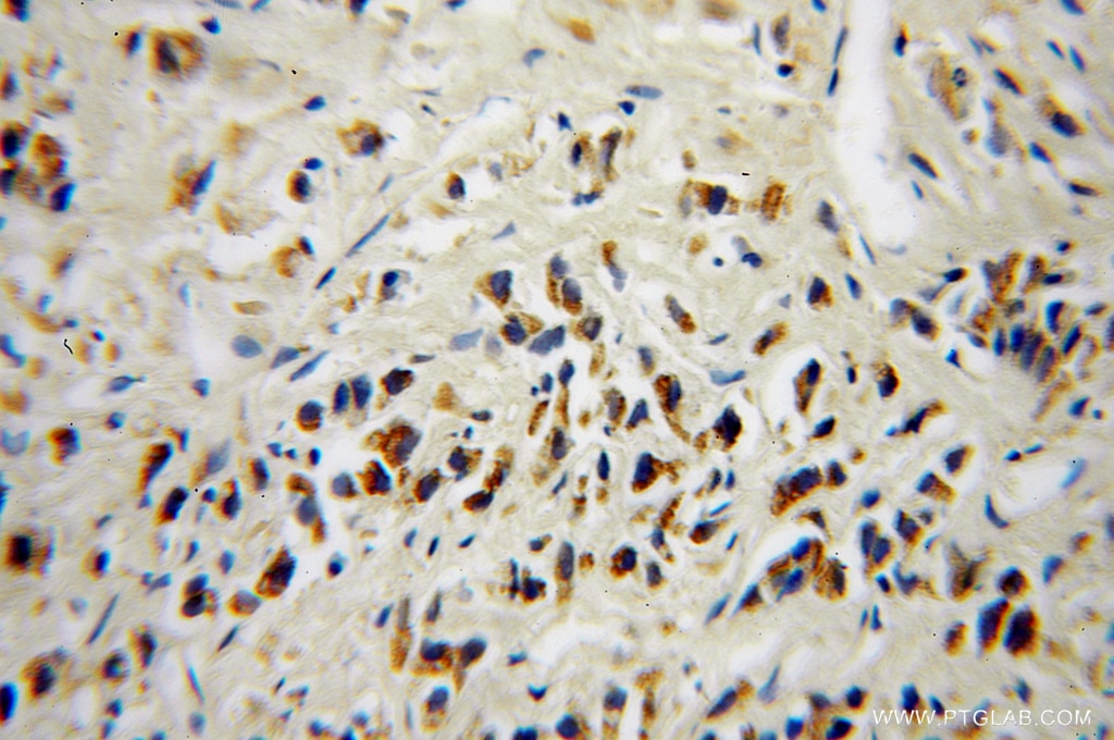 IHC staining of human prostate cancer using 10481-2-AP