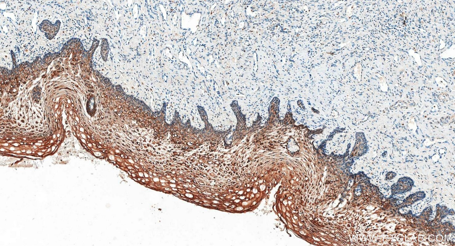 IHC staining of human cervical cancer using 34200-1-AP (same clone as 34200-1-PBS) Immunohistochemistry (IHC) staining of human cervical cancer tissue using DOLPP1 Polyclonal antibody (34200-1-AP)